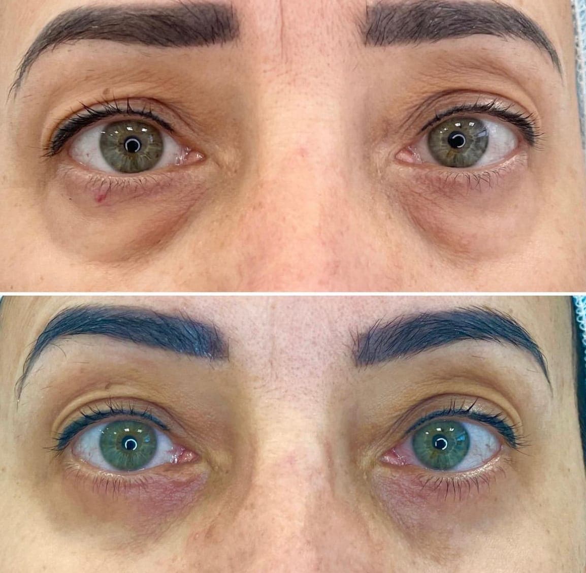 Przezspojówkowa blefaroplastyka