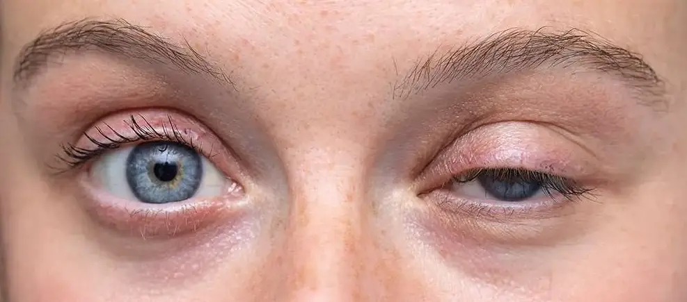 Ptoza oka operacja opadającej powieki