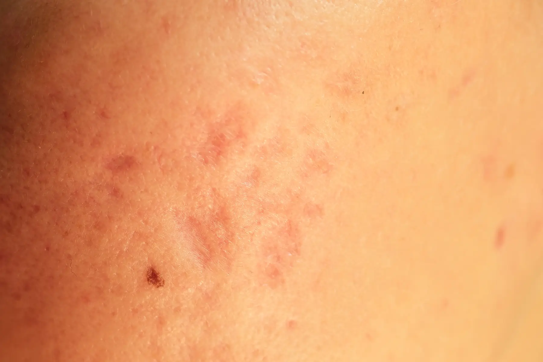 Terapia fotodynamiczna PDT